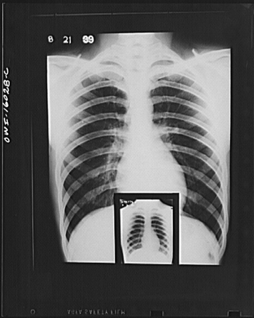 Alan Hart: TB&nbsp;Pioneer